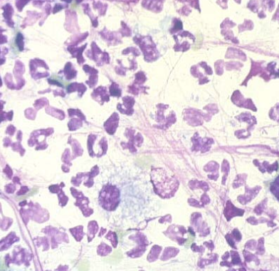 <p>1. color: cloudy</p><p>2. lactate: elevated (bc bacteria produce lactate)</p><p>3. TP: elevated</p><p>4. glucose: lower, differences >50mg/dL (bc bacteria are consuming glucose)</p><p>5. neutrophils predominate/may be degenerate, elevated-100,000 WBC, intracellular bacteria</p>