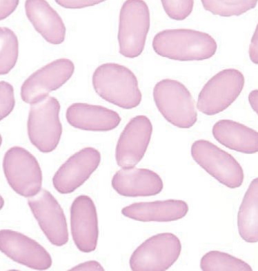 <p><span style="font-family: "Times New Roman", serif">Oval or elongated RBCs; seen in hereditary elliptocytosis and iron deficiency anemia.</span></p>