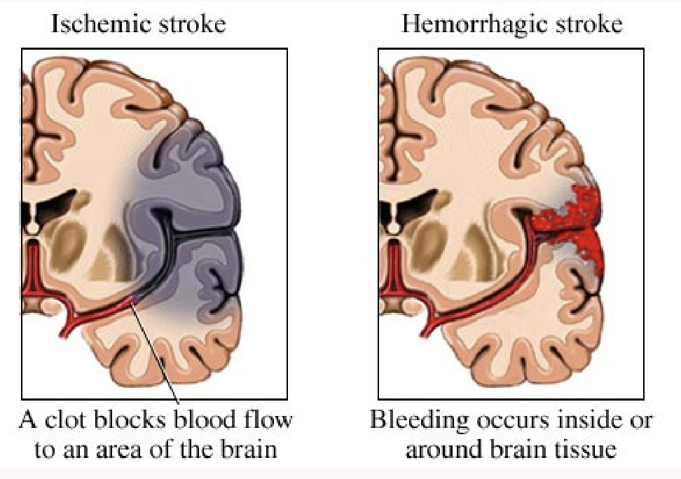 <p>Brain attacks. Occurs when something blocks the blood supply. </p>