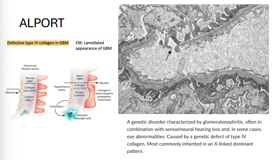 <ul><li><p><strong>Gene</strong>: <em>COL4A5</em> (most common, X-linked); less commonly <em>COL4A3/4</em> (AR/AD)</p></li><li><p><strong>Inheritance</strong>:</p><ul><li><p>X-linked dominant (classic)</p></li><li><p>Some forms AR/AD</p></li></ul></li><li><p><strong>Pathophysiology</strong>: Defective type IV collagen in basement membranes</p></li><li><p><strong>Clinical features</strong>:</p><ul><li><p>Glomerulonephritis → hematuria, progressive renal failure</p></li><li><p>Sensorineural deafness</p></li><li><p>Ocular findings (e.g., anterior lenticonus)</p></li><li><p>EM: “Basket-weave” appearance of GBM</p></li></ul></li></ul><p></p>