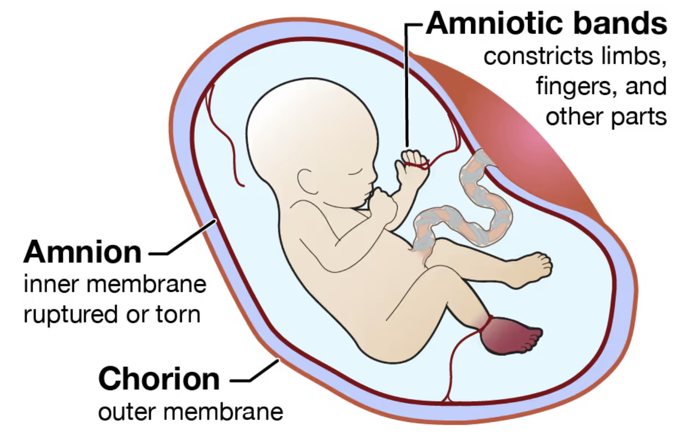 <p>the <strong><u>outer</u></strong> cell membrane of the fetal membrane that forms the amniotic sac</p><ul><li><p>toward the uterus that develops from the trophoblast</p></li><li><p>becomes the covering of fetal side of the placenta </p></li><li><p>contains major umbilical BVs</p></li></ul><p></p>