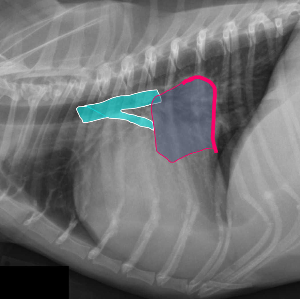 <p>-dorsal displacement of main stem bronchi by a hunchback bump</p><p>-increased cd.dorsal cardiac border</p><p>-loss of cd.cardiac waist - straightening of cd.cardiac margin</p><p></p>