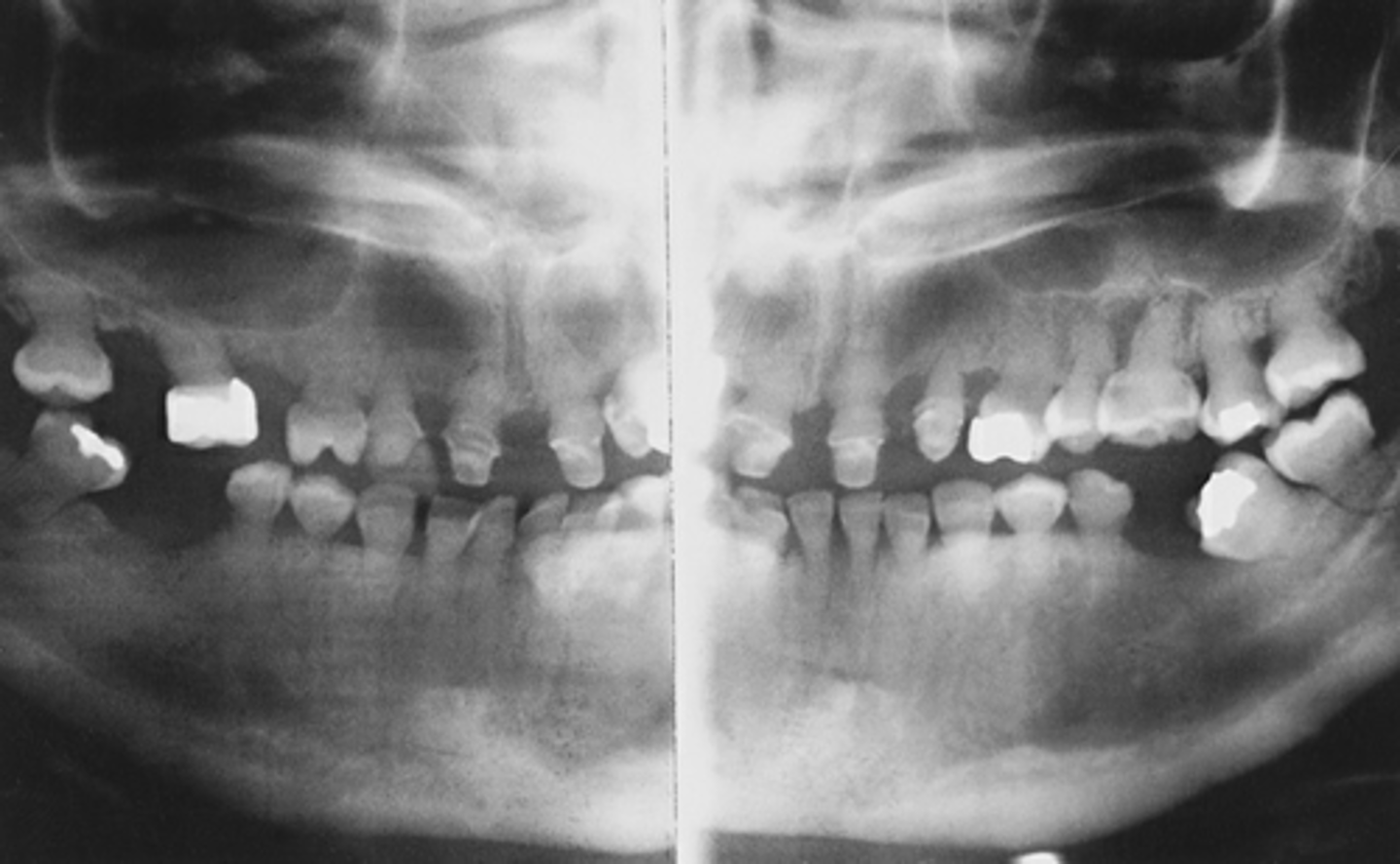 <p>-shorts roots almost complete lack of pulp chamber</p><p>-is marked by bulbous crowns that are colored from opalescents brown to brownish blue</p>