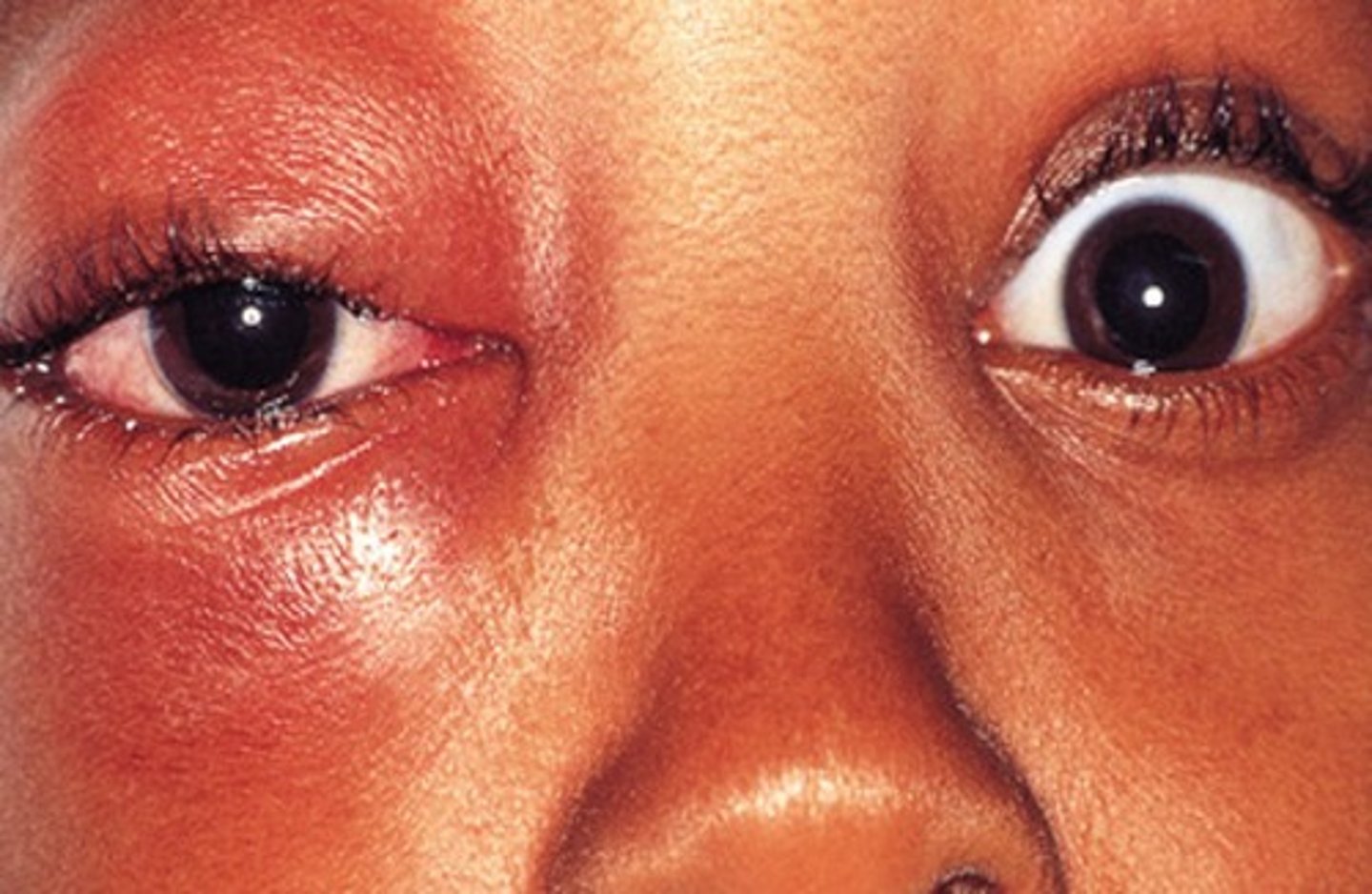 <p>yes! It can even increase to orbital cellulitis (in the eye)</p>