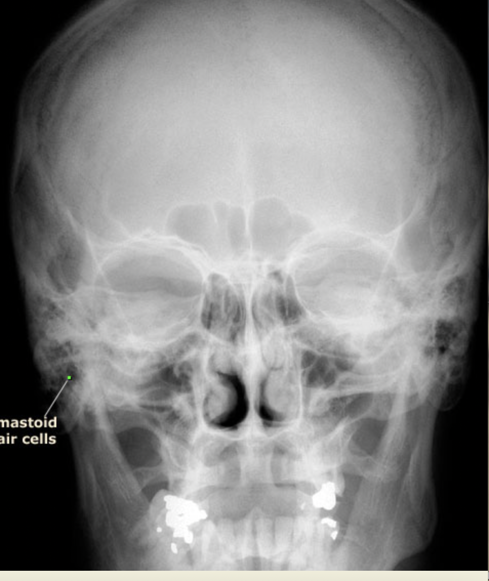<p>Air cells and sinuses</p>