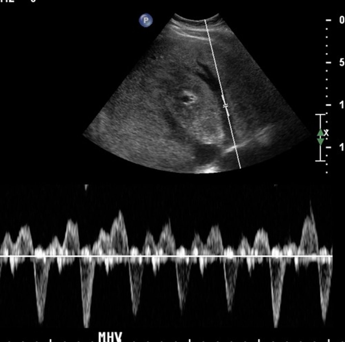<p>Compromised flow - over congestion</p><p>"w" pattern</p>