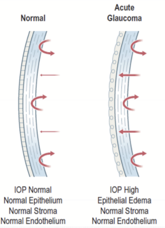 <p>Epithelial edema without stromal edema. IP becomes positive, causing water to be pushed out of the stroma. Epithelial microcysts are often present.</p>