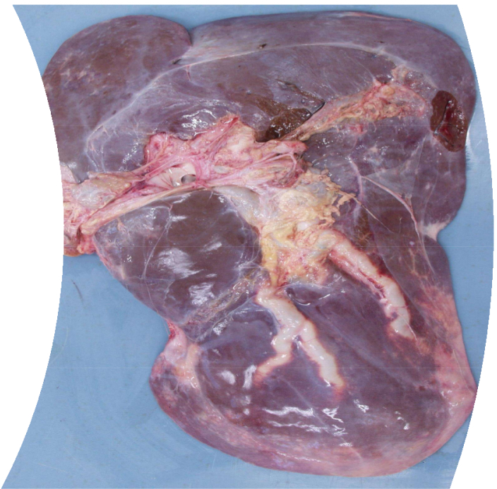 <ol><li><p><strong>Compulsory inspection of cattle liver</strong></p></li><li><p><strong>Describe using 4 words</strong></p></li><li><p><strong>Potential diagnosis- </strong>fasciola hepatica (fasciolosis)</p><ol><li><p>Migrate through liver causing fibrosis and adult flukes live in large bile ducts which become thickened or calcified (pipe stem)</p></li><li><p>Fluke favorite the ventral and caudal lobe- become atrophied and dorsal lobe enlarged so liver as a whole becomes rounded outline</p></li><li><p>Cattle develop good immunity to fluke so may or may not be present in bile ducts</p></li></ol></li><li><p><strong>Judgement</strong>- local rejection unless it has systemic effects (protein deposit effects, hardened fat, emaciated, etc)</p><ol><li><p>Category 3 because safe for pet consumption</p></li></ol></li></ol><p></p>