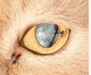 <p>is this a diabetic cataract?</p>