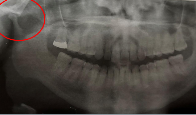 <p>underdeveloped condyle</p>
