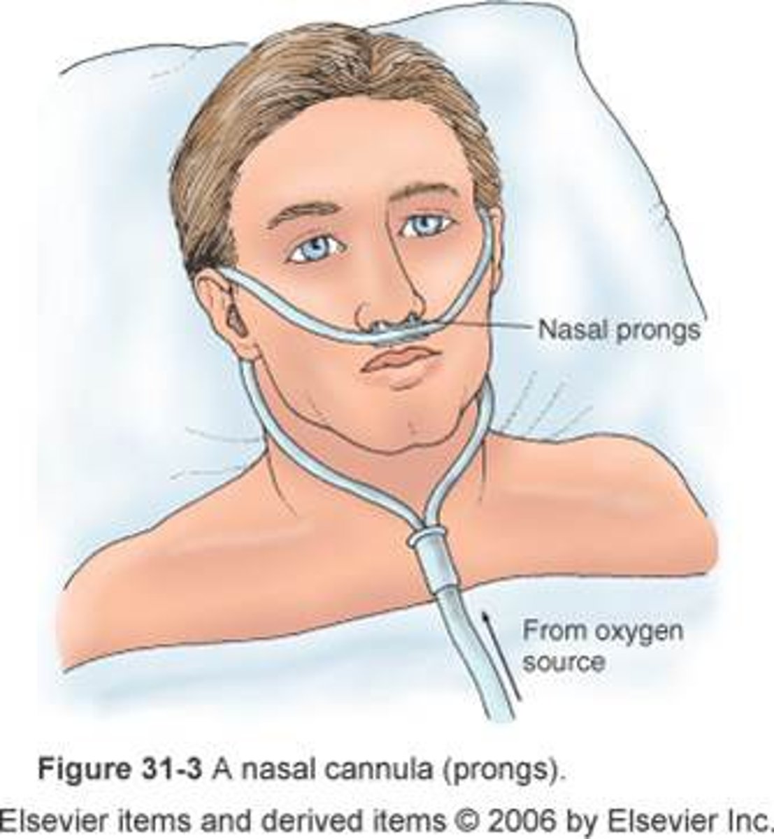 <p>a nasal oxygen delivery system with two prongs placed in the nostrils</p>