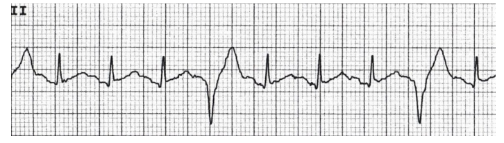 <p>What can be seen here?</p><p>-Refers to the presence of one PVC after every 3 normal beats</p>