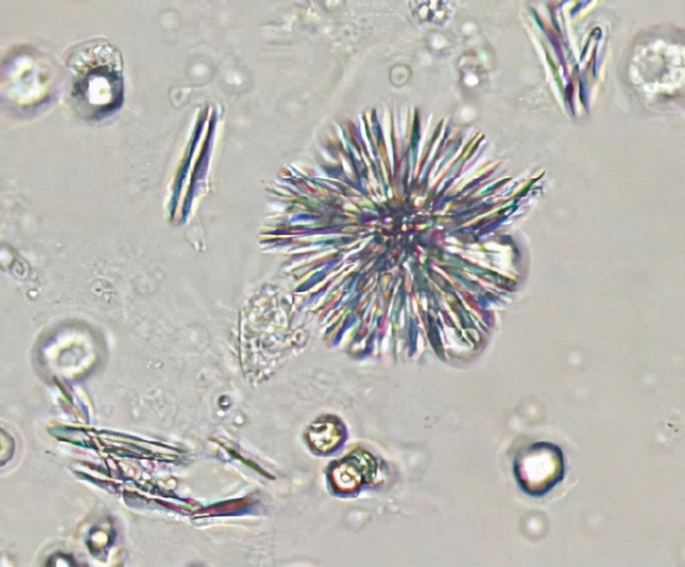 <p>Form in acidic pH</p><p>Associated with inborn errors of metabolism such as tyrosinemia and certain liver disorders. </p>