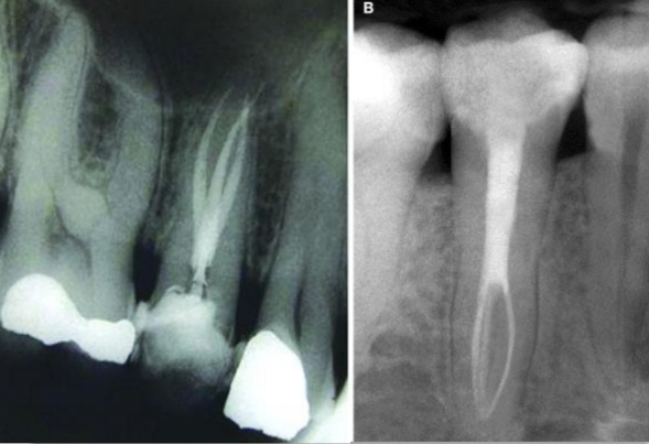 <p><strong>Maxillary </strong>- 3 roots</p><p class="has-focus"><strong>Mandibular </strong>- 2 roots</p>