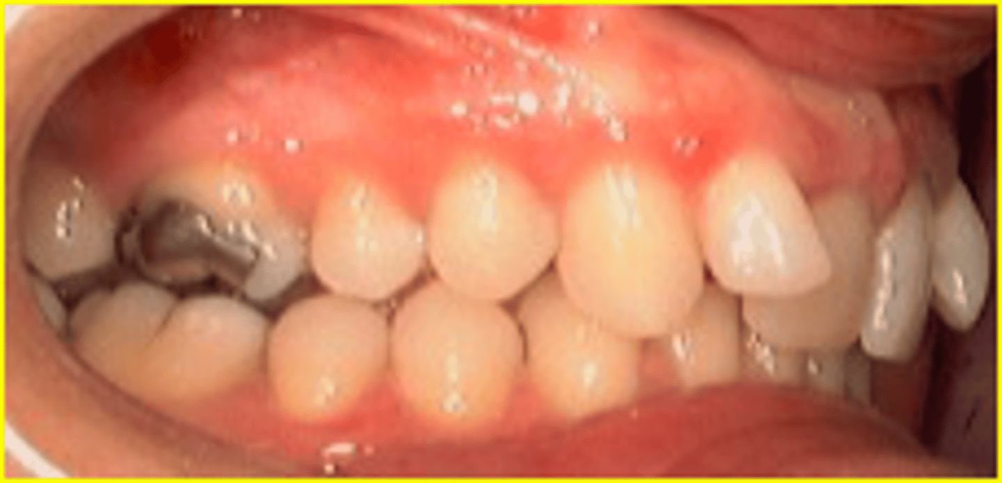 <p>ID the class of occlusion:</p>