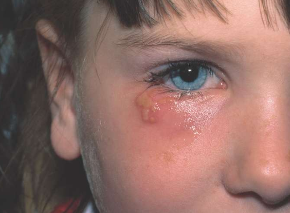 <p>Welke virale infectie / kenmerk zien we heir?</p>