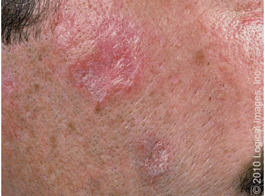 <p>What form of CLE is characterized by chronic skin RAISED, disc shaped erythematous plaque with adherent keratotic scales on the face, neck, and scalp that lead to scarring, skin atrophy (permanent alopecia and disfigurement)</p>