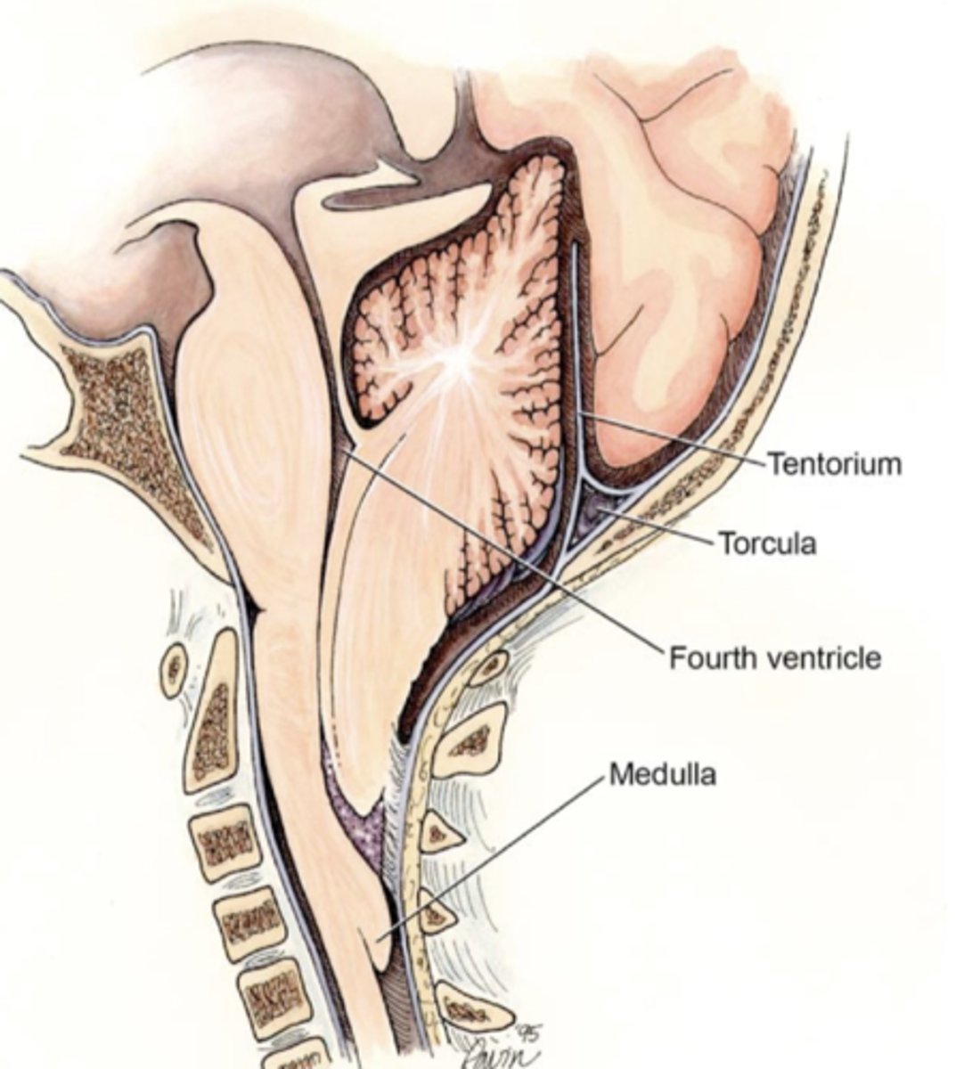 <p>1. Extrusion of cerebellum and brianstem below foramen magnum</p><p>2. Variable effects: sensory and motor symptoms through the paralysis, brainstem damage and hydrocephalus</p><p>3. May require prenatal surgical decompression of brain as an emergency</p>