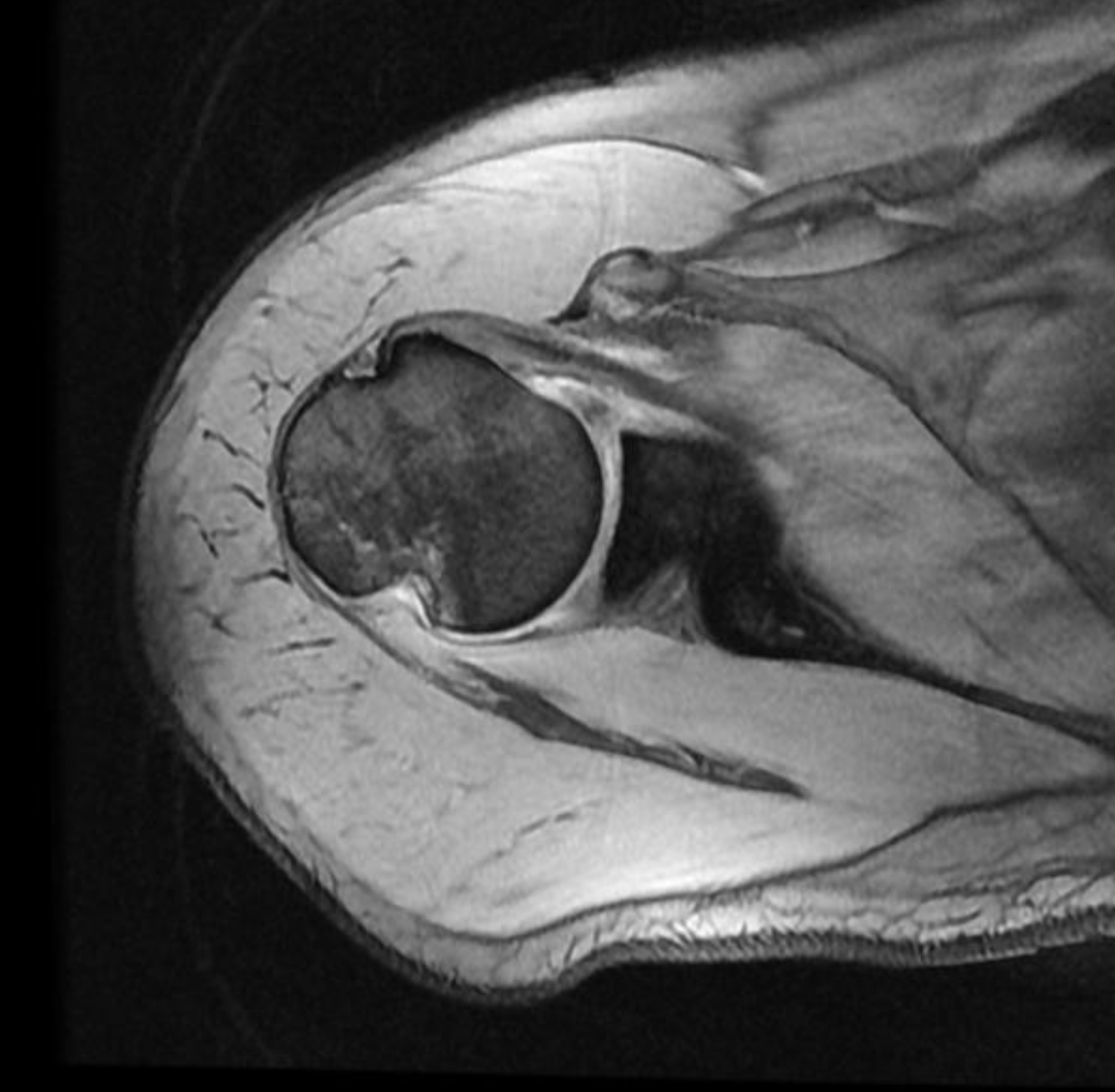<p>What is the likely injury in this MRI?</p>