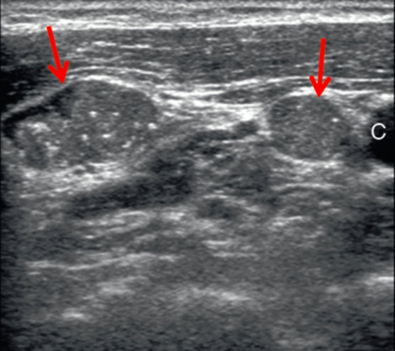<p>c. Metastatic disease within lymph nodes</p>