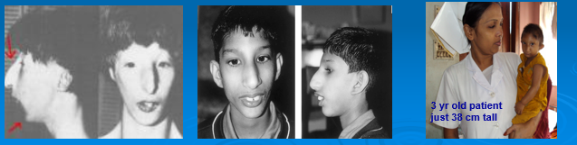 <ul><li><p>Proportionate dwarfism</p></li><li><p>Severe microcephaly with “bird-headed” appearance (protruding nose, large eyes, low ears, small chin)</p></li><li><p>Mental retardation</p></li></ul><p></p>