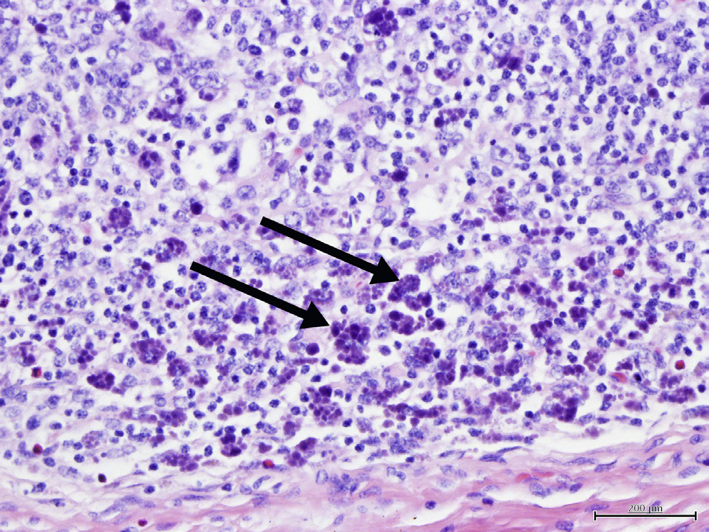 <p>What viral syndrome is the cause of these botryoid inclusion bodies indicated by the black arrows? </p>
