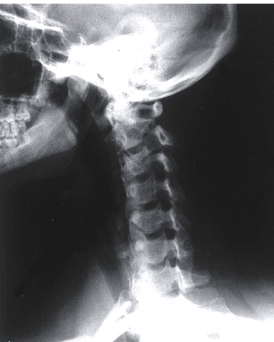 <p>what view is this?</p><p>a. lateral</p><p>b. odontoid</p><p>c. AP</p><p>d. oblique</p>