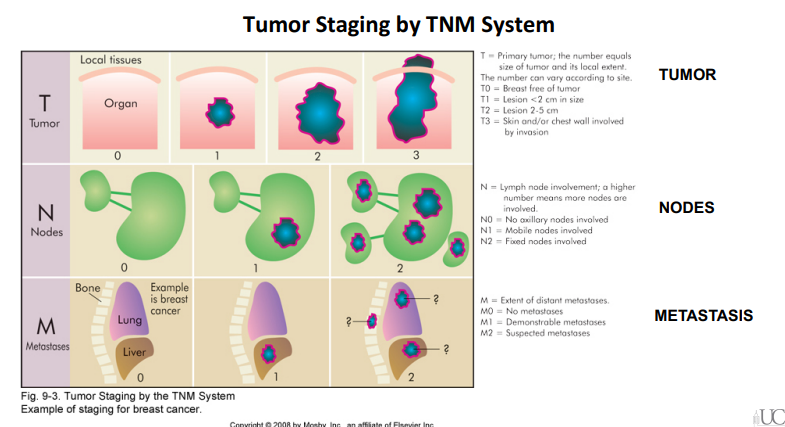 <p>The TNM system is used to stage malignant tumors based on the tumor size and invasiveness, the number of lymph nodes affected, and the presence of distant metastasis.</p>