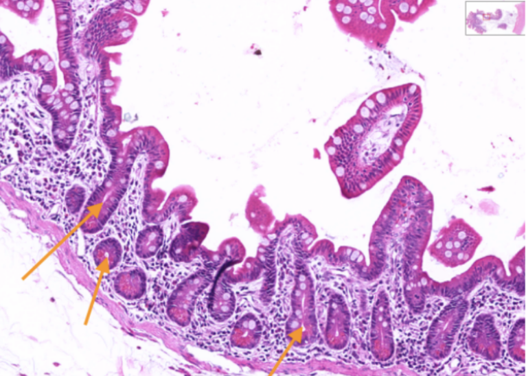 <p><span>Ducts whose openings can be traced onto the surface epithelium.</span></p>