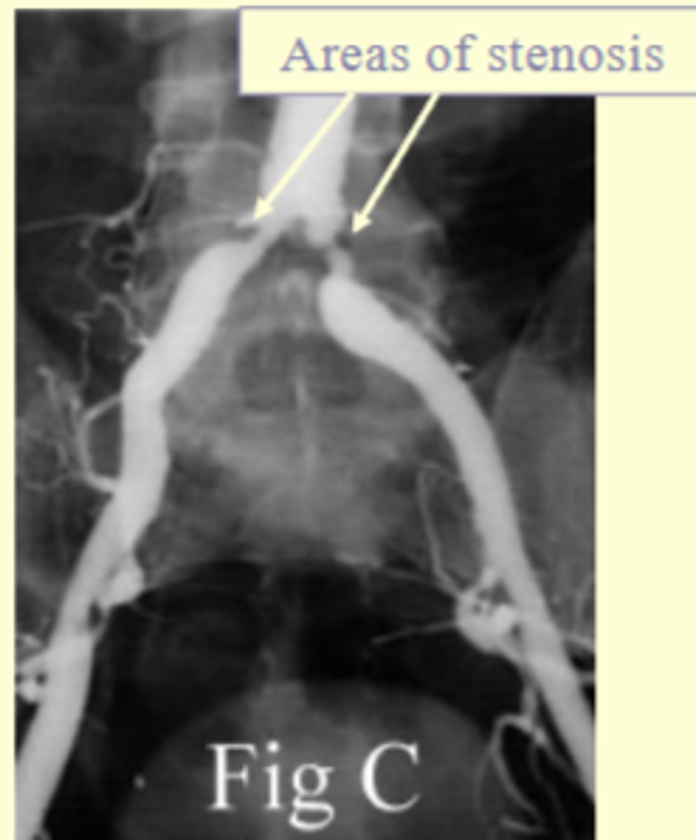 <p>Stenosis due to atherosclerosis (fatty deposits in the artery); alleviates stenosis and restores blood flow</p>