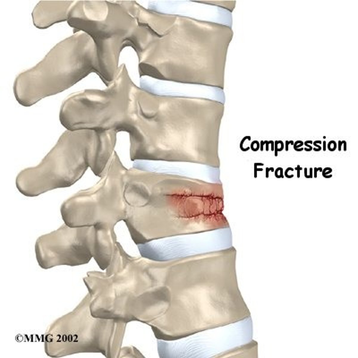 <p>A compression fracture of a vertebral body followed by hip fractures</p>