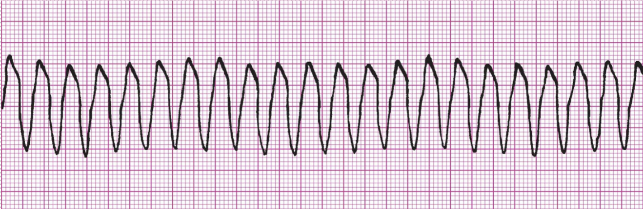 <ul><li><p class="Paragraph SCXW184685097 BCX0" style="text-align: left;"><span style="line-height: 24.4125px;"><strong>Fast, no P wave, Regular, Wide QRS, Negative deflection</strong>&nbsp;</span></p></li></ul><ul><li><p class="Paragraph SCXW184685097 BCX0" style="text-align: left;"><span style="line-height: 24.4125px;">Compression and epi <strong>IF</strong> no pulse&nbsp;</span></p></li></ul><p></p>