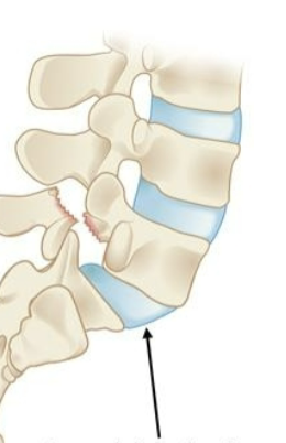 <p><strong>What is Spondylolisthesis?</strong></p>