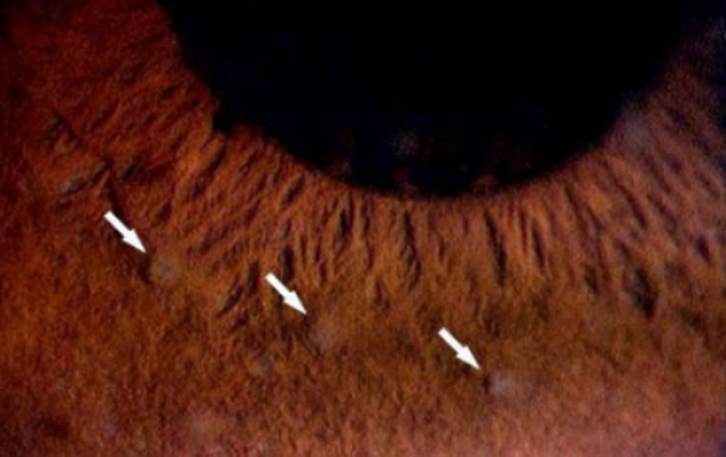 <p>inflammatory nodules of the iris stroma slightly displaced from the pupil border. Is indicative of granulomatous inflammation.</p>