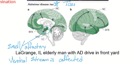 <ul><li><p>Sleep disturbances</p></li><li><p>Contrast Sensitivity </p><ul><li><p>Tasks difficult with inadequate light</p></li><li><p>Driving after dusk and before dawn</p></li></ul></li><li><p>Losing self and others</p><ul><li><p>Environmental agnosia: lost in familiar surroundings </p></li><li><p>Difficulty with figure-ground discrimination: foreground/background confusion </p></li><li><p>Prosopagnosia: inability to recognize faces </p></li></ul></li><li><p><s>RNFL thinning: glaucoma/glaucoma-like</s></p></li><li><p><s>Convergence insufficiency </s></p></li><li><p><s>Hemispatial neglect </s></p></li></ul><p></p>