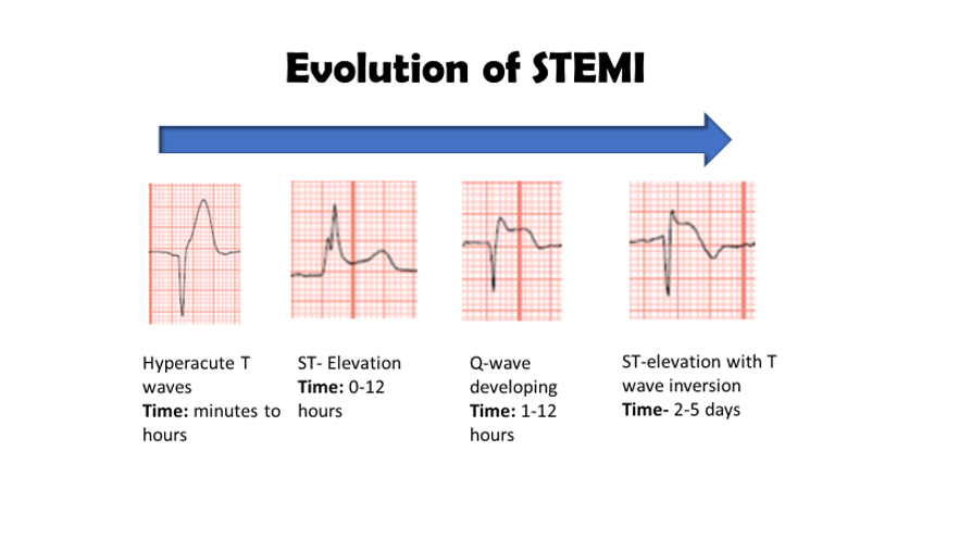 <p><strong>Hyperacute T-waves and ST-elevation.</strong></p><p>Hyperacute T-waves are an early sign of myocardial infarction (heart attack) characterized by<strong> tall, peaked T-waves on an electrocardiogram (ECG).</strong> They indicate <strong>severe ischemia and are often followed by ST-segment elevation.</strong></p>