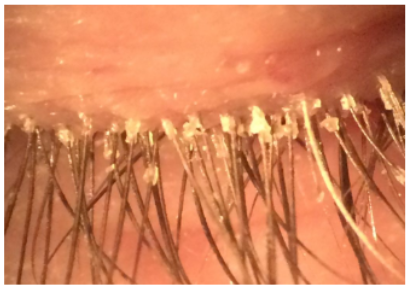 <p>anterior blepharitis </p>