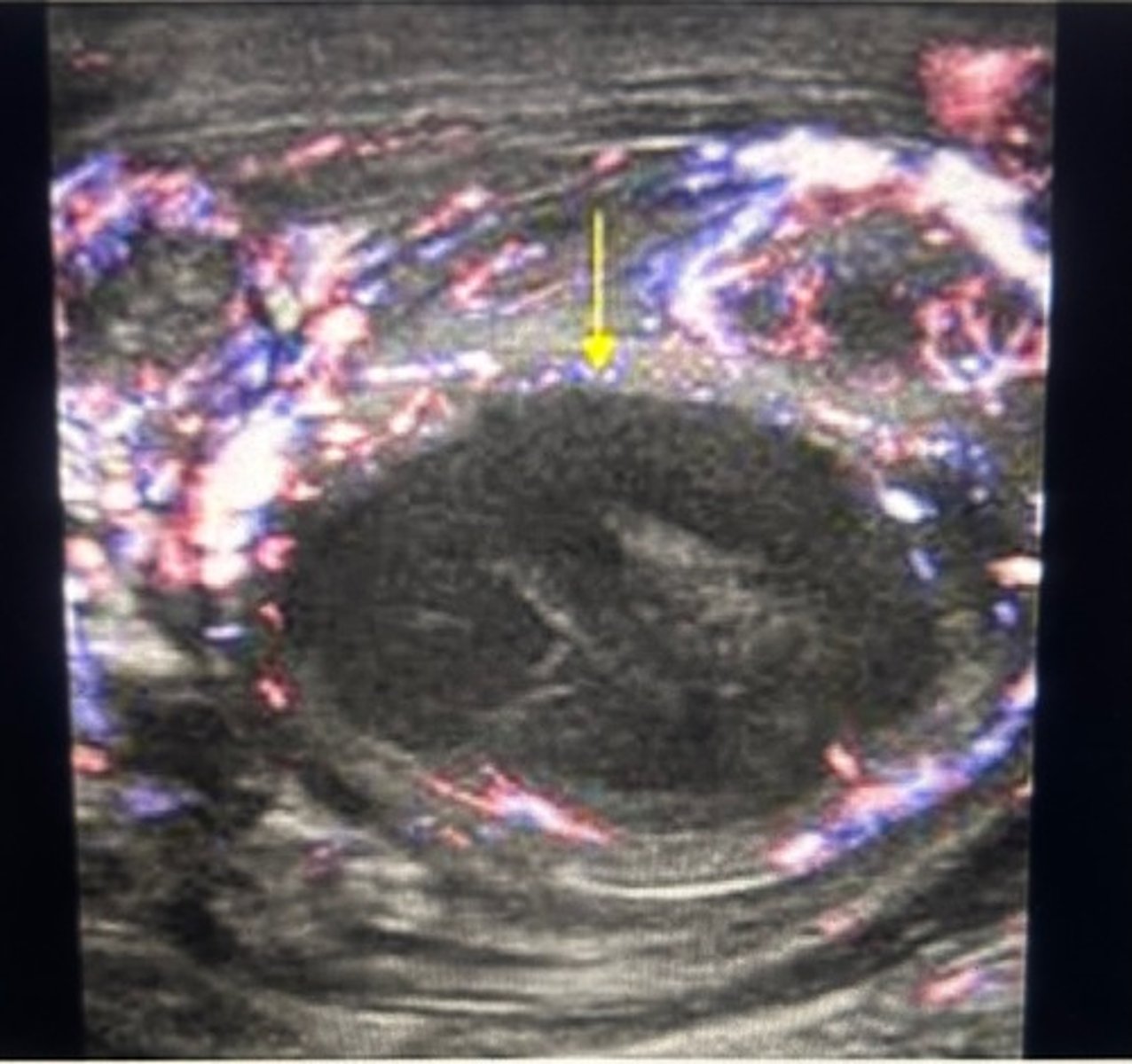 <p>Power Doppler demonstrates an avascular intratesticular mass with increased peripheral vascularity</p><p>The hypoechoic mass represents abscess formation due to the infection in the testicle. Hyper vascularity is common at the periphery of an abscess.</p>