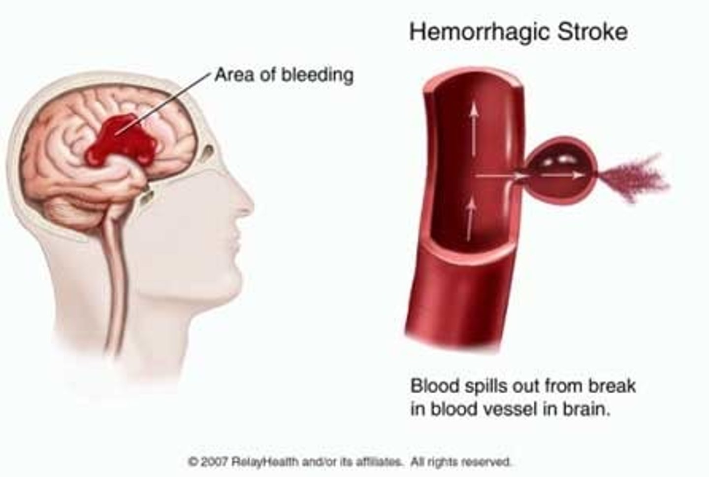 <p>when a blood vessel in the brain bursts, causing bleeding (hemorrhage) in or around the brain. This bleeding increases pressure on brain tissue, leading to cell damage and loss of brain function</p>