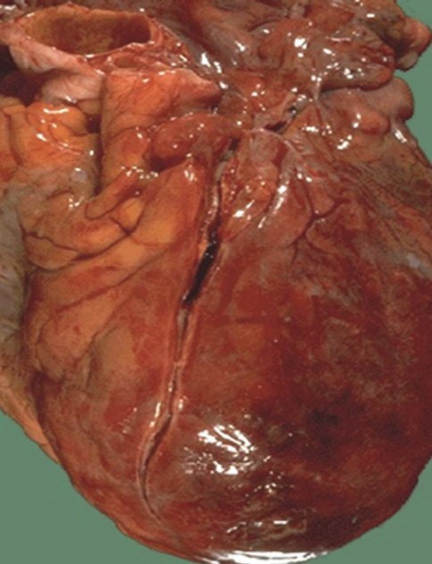 <p>Acute Myocardial Infarct (MI)</p>