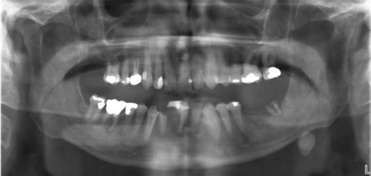 <p>ID the pathology:</p>