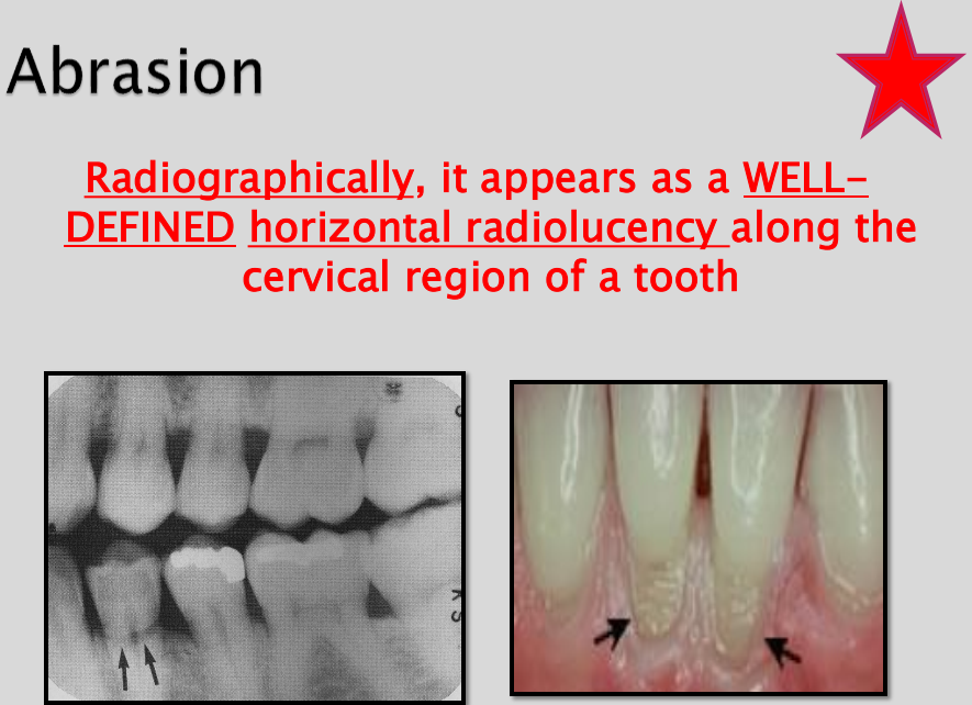 <p>Abrasion </p>