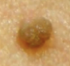 <p>Common Skin Variation</p><ul><li><p>Raised papule but with <strong>depressed</strong> center</p></li><li><p>Common with elderly clients; normal</p></li></ul><p></p>