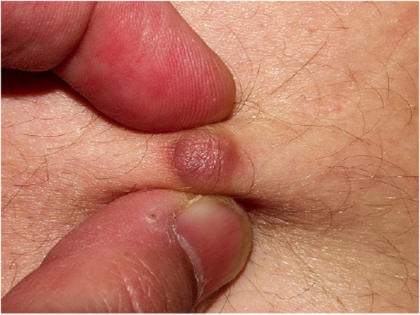 <p>fibrous tumor of the skin</p>