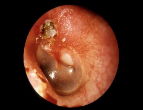 <p>identify the appropriate finding with the following tympanic membrane:</p>