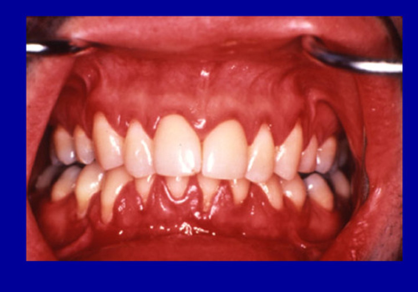 <p>• persistent, linear, easily bleeding, erythematous gingivitis</p><p>• possible etiologic role for candidial species</p>