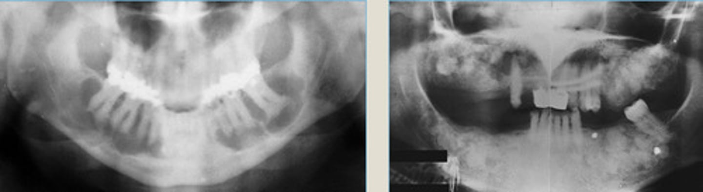 <p>LEFT: radiolucent phase</p><p>RIGHT: Radiopaque phase</p><p>2 contraindications?</p>