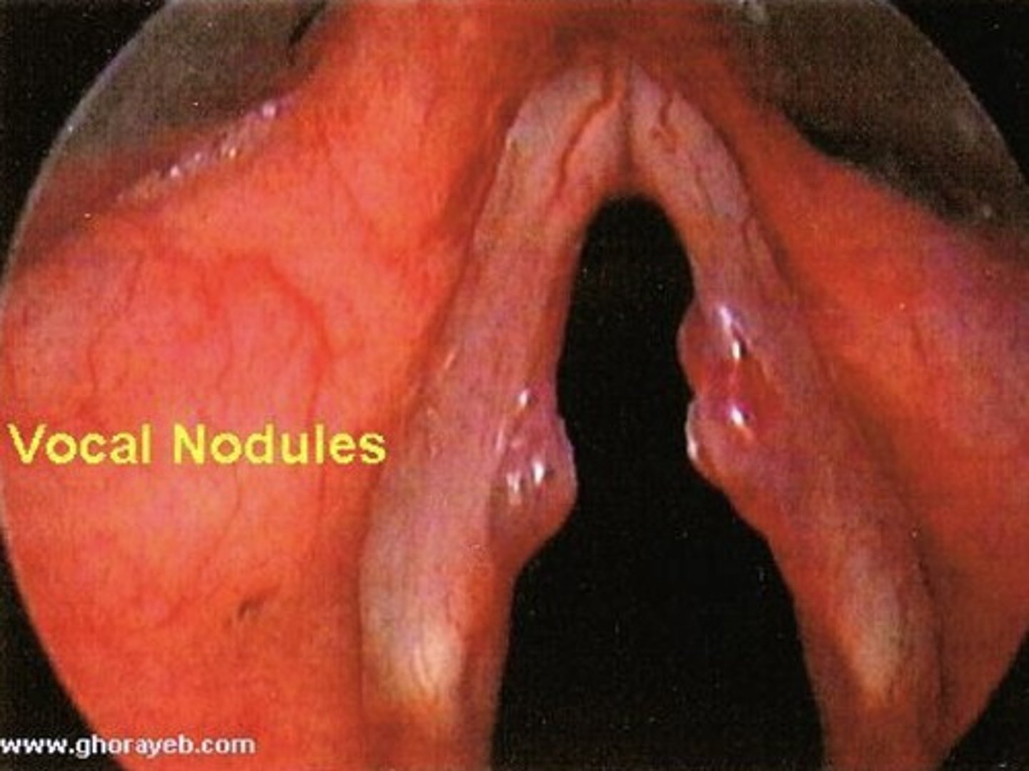 <p>small inflammatory or fibrous growth that develops on the vocal cords of people who constantly strain their voices ==&gt; makes the voice breathy &amp; hoarse </p><p></p><p>*<strong>usually appears in pairs &amp; looks structurally similar to callus on a hand</strong> </p>