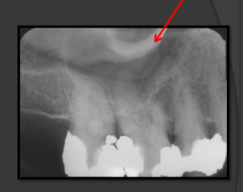 <p>-Radio-opaque</p><p>-A U shaped line that sits above the molars</p>