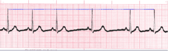 <p>What does this EKG show? </p>